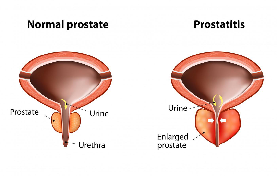 Normale Prostata eines gesunden Mannes und Entzündung der Prostata mit Prostatitis