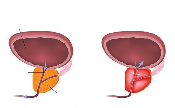normale und entzündete Prostata